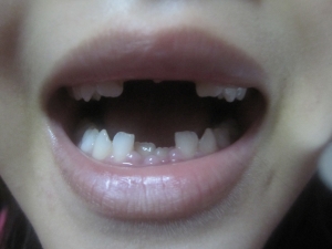 上前歯2